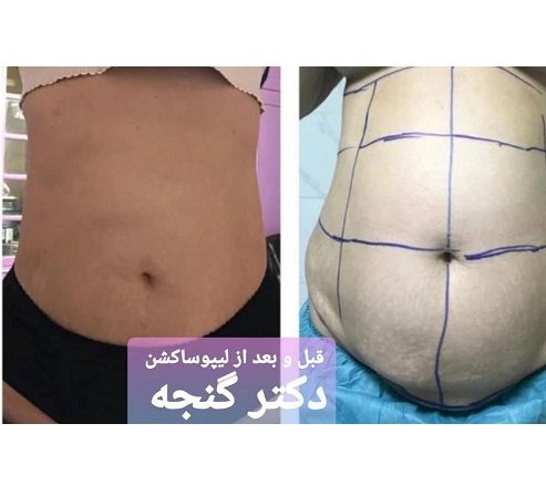 بهترین جراح چاقی و بای پس تهران