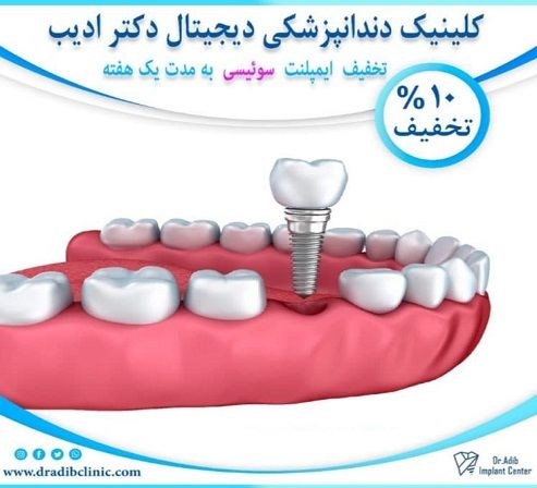 کلینیک ایمپلنت تهران